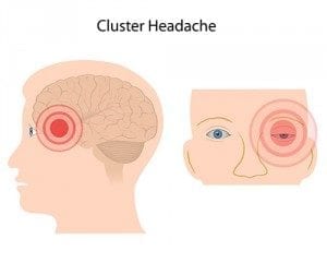 cluster headache issue