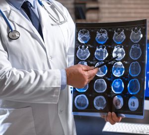 Brain MRI Scan / Memory Loss