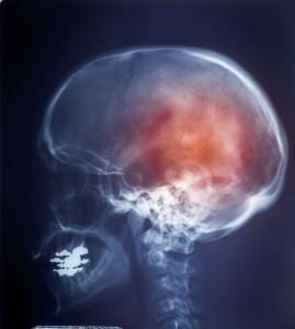 Migraine Headache x ray