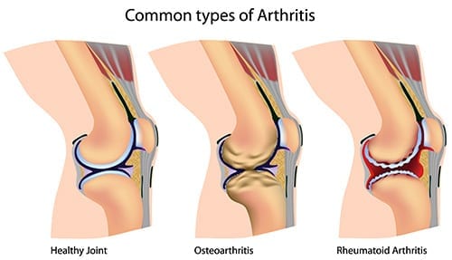 Arthritic Joints 